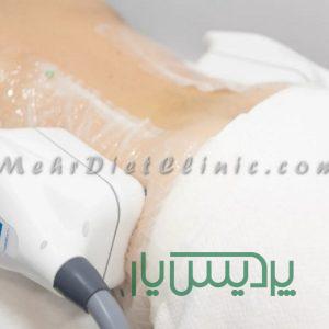 چربی سوزی شکم و پهلو با دستگاه لاغری چربی شکن