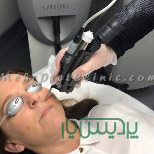 دستگاه لیزر مو های زائد